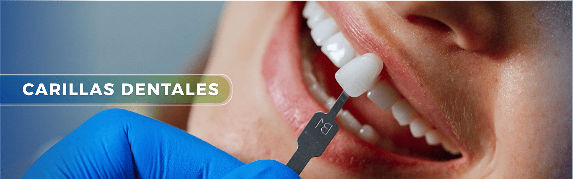 carillas dentales spa odontologico internacional arequipa