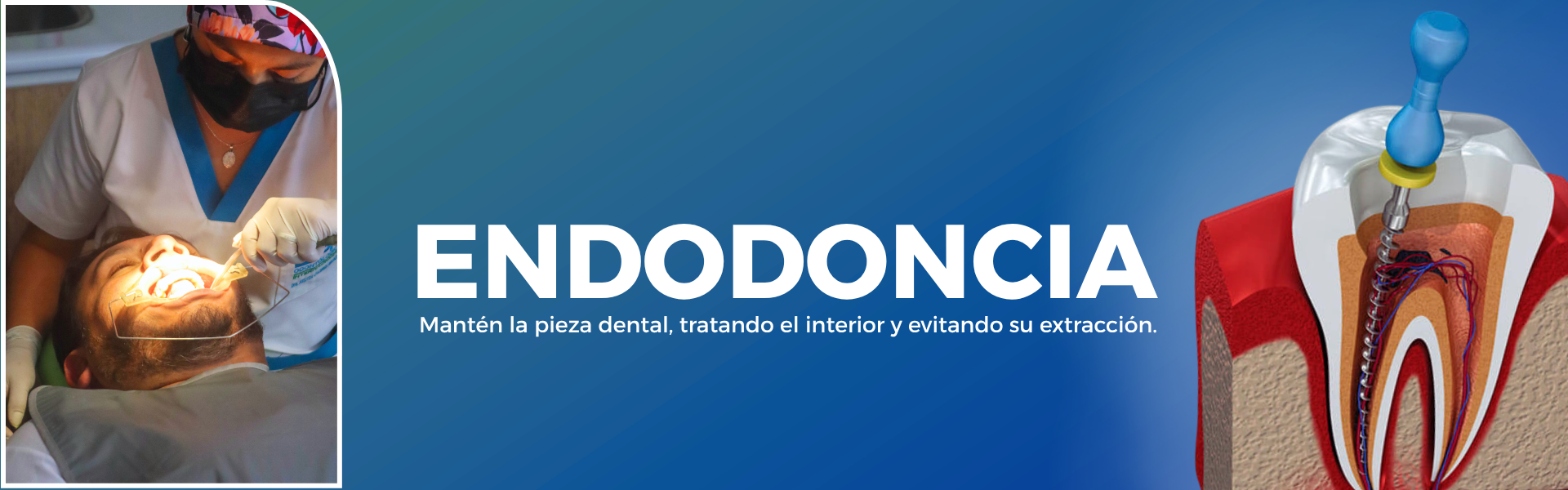 Endodoncia spa odontologico internacional